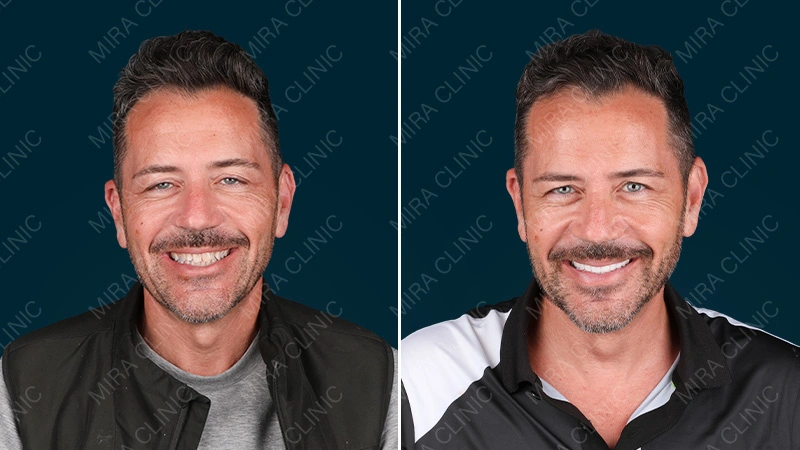 Before and After veneers
